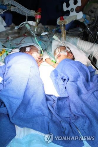 스위스서 생후 8일 샴쌍둥이 분리수술 성공…최연소 기록 - 3