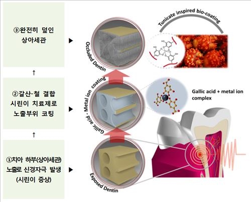 멍게 혈액 추출물로 시린 이 치료소재 개발 - 2