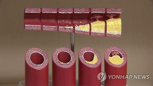 "중성지방 많은 중년 여성, 골절 위험↑" - 2