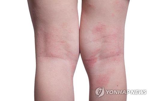아토피피부염