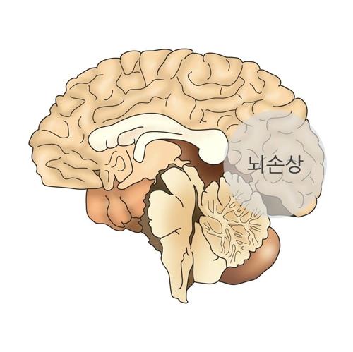 외상성 뇌 손상(TBI)