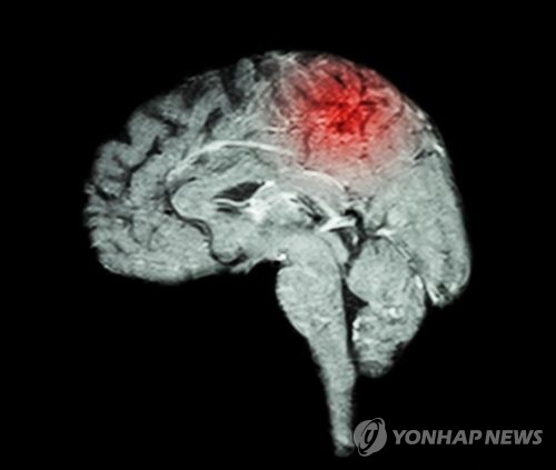 뇌졸중