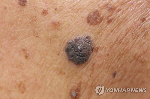 피부암