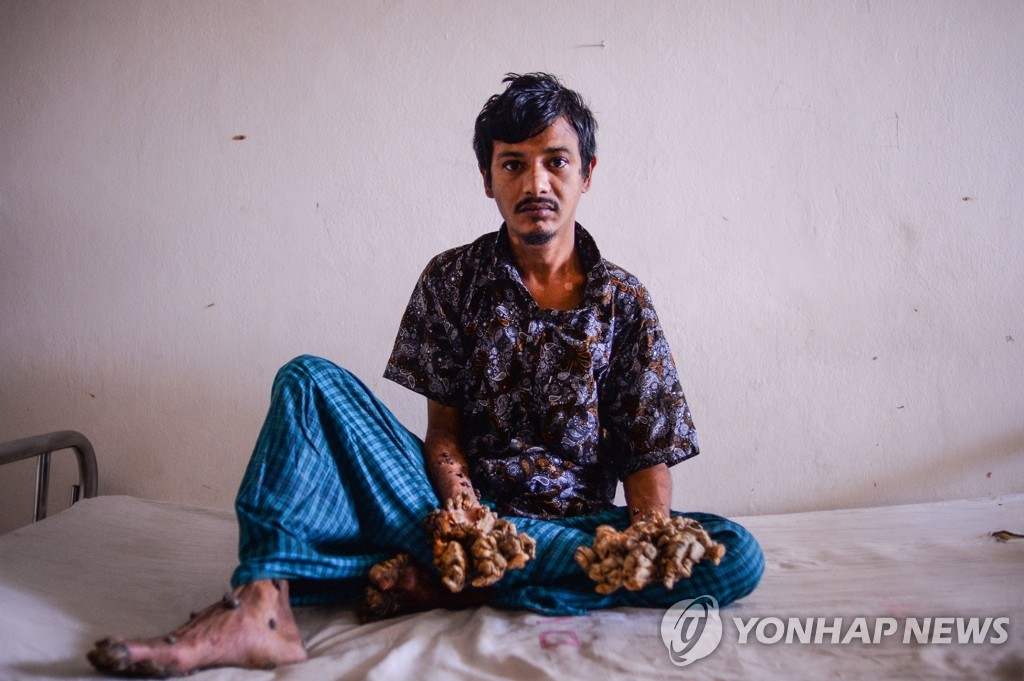 BANGLADESH-HEALTH-TREEMAN