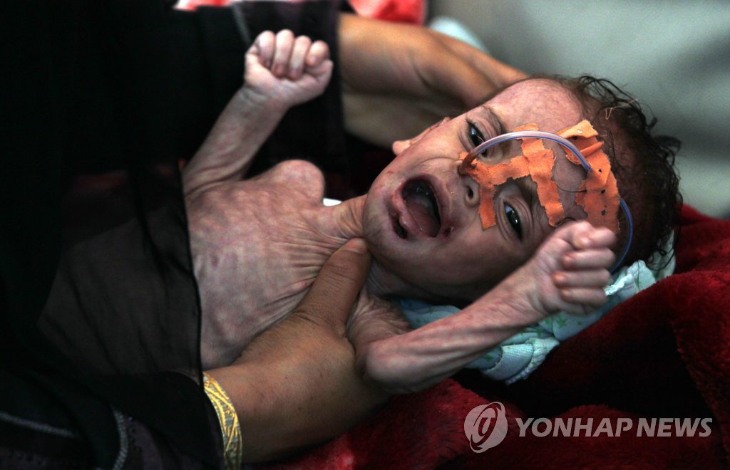 '이것이 전쟁의 얼굴'…영양실조로 치료를 받는 예멘 어린이