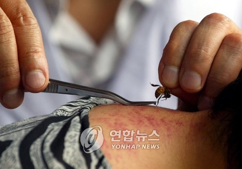 (EPA) 중국 봉침시술