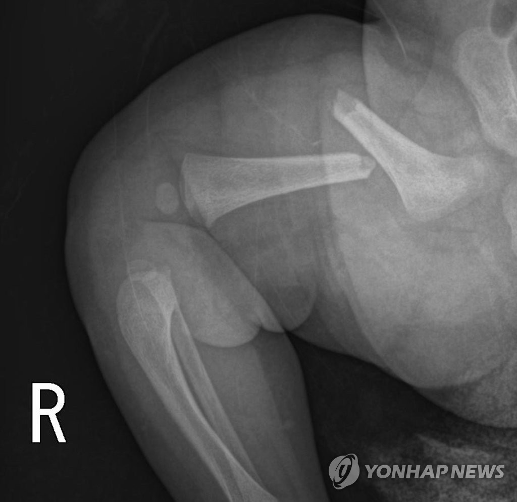 생후 50일 여아의 부러진 허벅지뼈