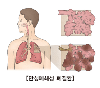 만성 폐쇄성 폐 질환(COPD)