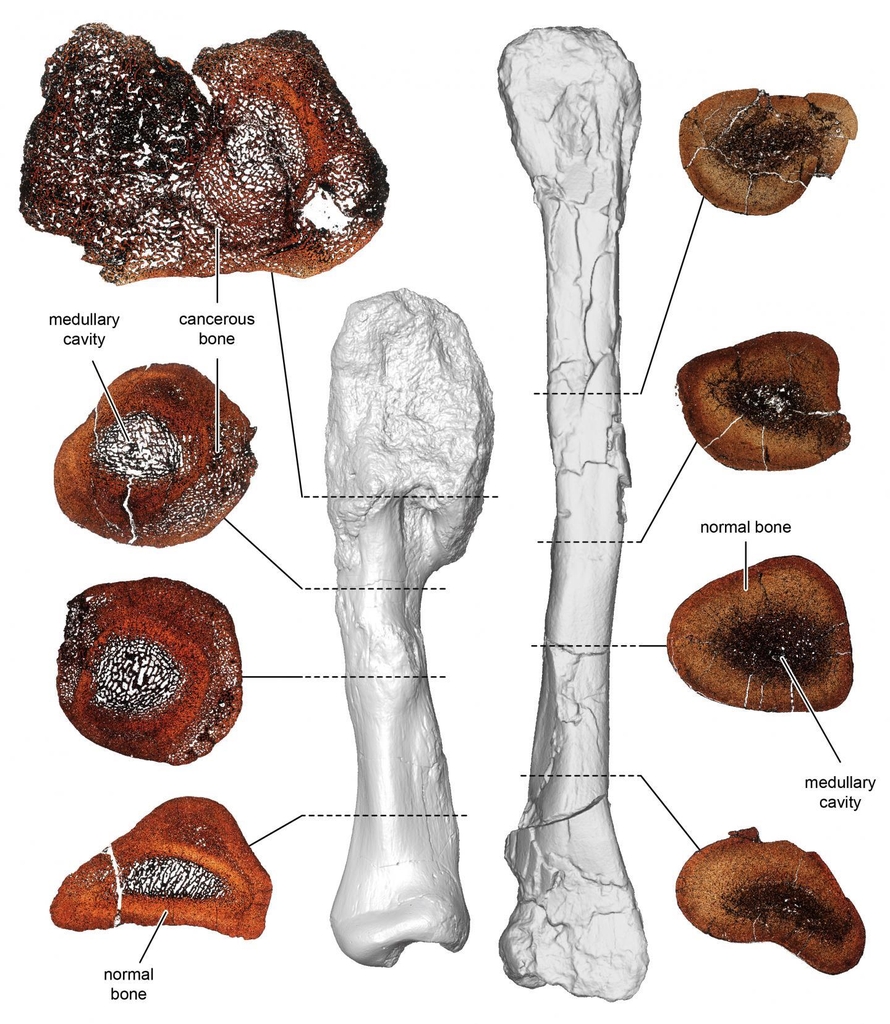 골육종 뼈(왼쪽)와 정상 뼈 화석 비교 