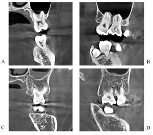치아 뿌리가 상악동 동굴 내부로 들어간 CBCT 사진 (A,B), 상악동 동굴 내부로 들어가지 않은 CBCT 사진 (C,D) A,C는 관상면(신체를 앞뒤로 나누는 가상의 면) B,D는 시상면(신체를 좌우로 나누는 가상의 면) [서울성모병원 제공]