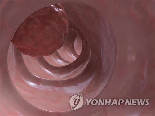대장암