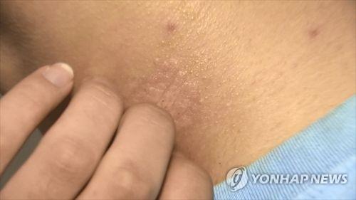 [위클리 건강] ‘Psoriasis’, a silvery white dead skin that reduces quality of life… “30% of patients give up treatment”