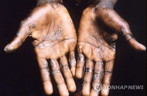 1997년 아프리카 콩고의 원숭이두창 환자